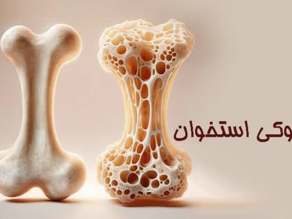 پوکی استخوان (2)